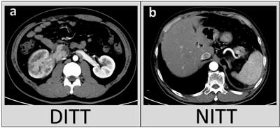 Influence of Deep Invasive Tumor Thrombus on the Surgical Complexity and Prognosis of Patients With Non-Metastatic Renal Cell Carcinoma Combined With Venous Tumor Thrombus